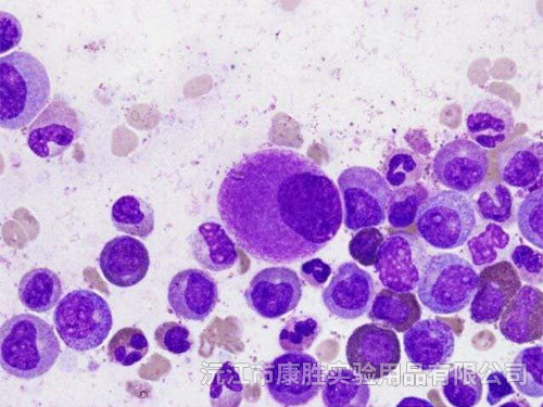 慢性粒細胞白血?。–ML)